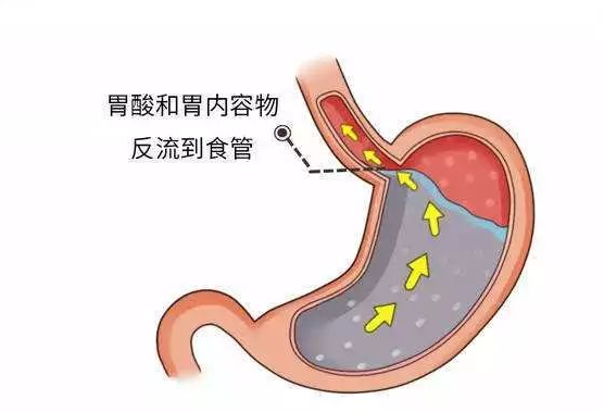 胃食反流最新治疗