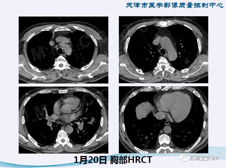 最新型冠状肺炎病毒