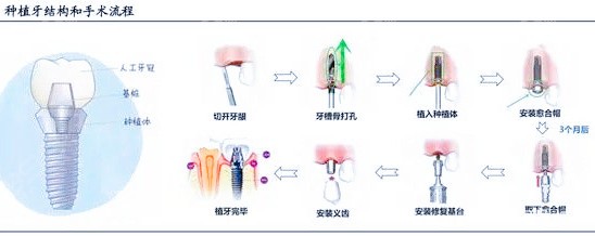 现在最新的种牙技术