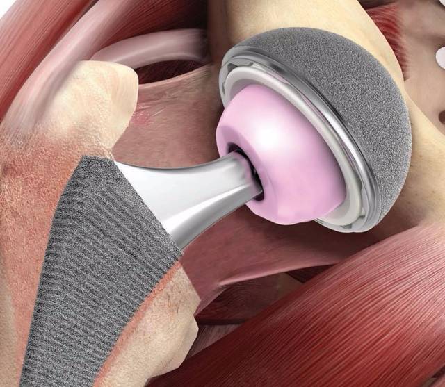 髋关节置换最新材料